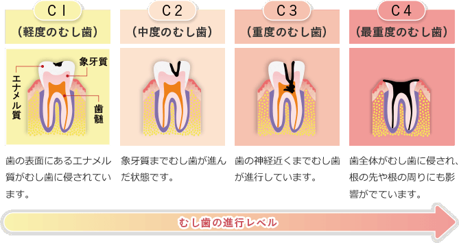 イラスト：むし歯の進行レベル