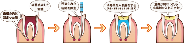 イラスト：歯をなるべく抜かないための根管治療