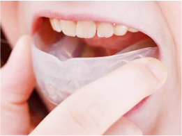 写真：マウスピースによる歯ぎしり治療