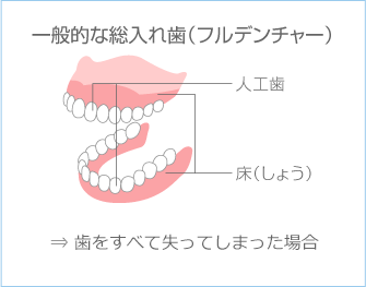 イラスト：入れ歯とは？