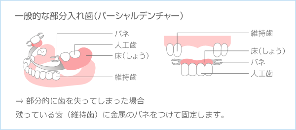 イラスト：入れ歯とは？