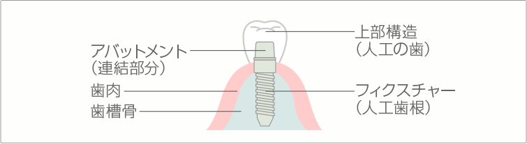 写真：インプラント