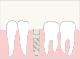 イラスト：インプラント治療の流れ