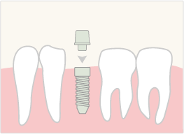 イラスト：インプラント治療の流れ