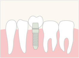 イラスト：インプラント治療の流れ